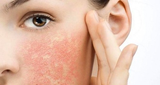 Dị ứng nổi mề đay nên kiêng gì? Thực phẩm bị mề đay nên ăn
